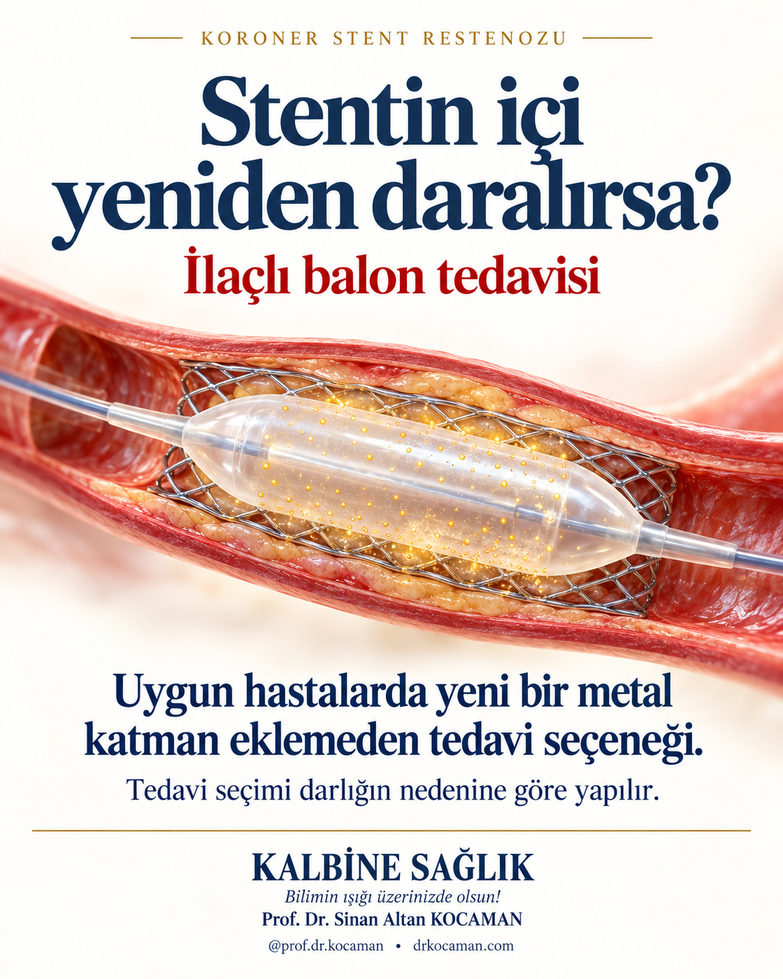 Stent içi yeniden daralmada ilaçlı balon tedavisi — için tıbbi bilgilendirme görseli