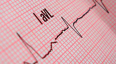 Ambulatory ECG (Holter) Monitoring — medical information image