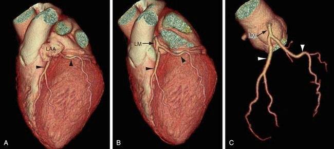 Coronary CT Angiography — medical information image