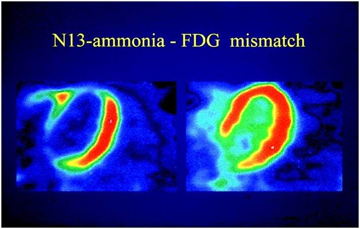 Cardiomyopathies — image d’information médicale