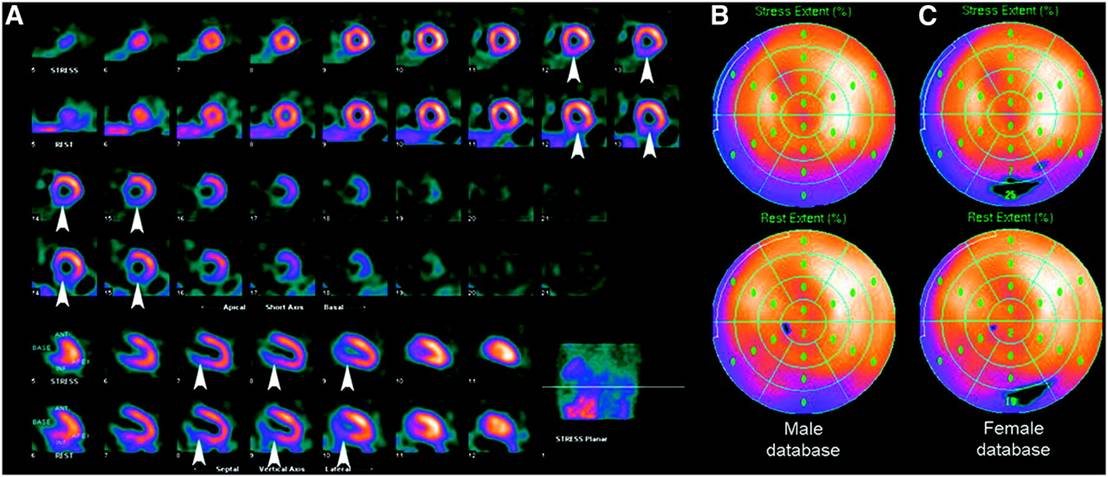 Myocardial Perfusion Scintigraphy — medical information image