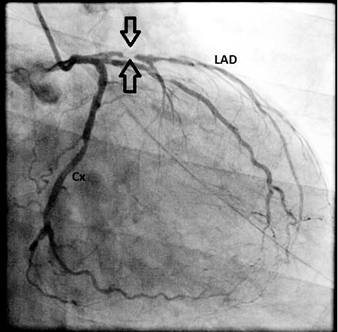 Stable Angina — medical information image