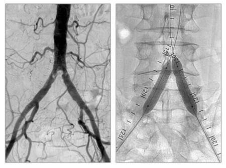 Artériopathie périphérique — image d’information médicale