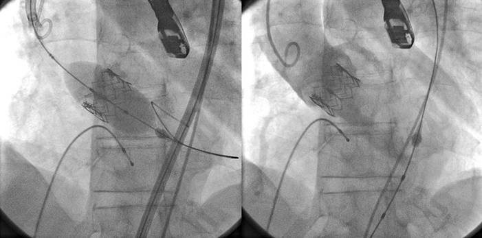 Rétrécissement de la valve aortique — image d’information médicale